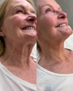 Neck Rejuvenation