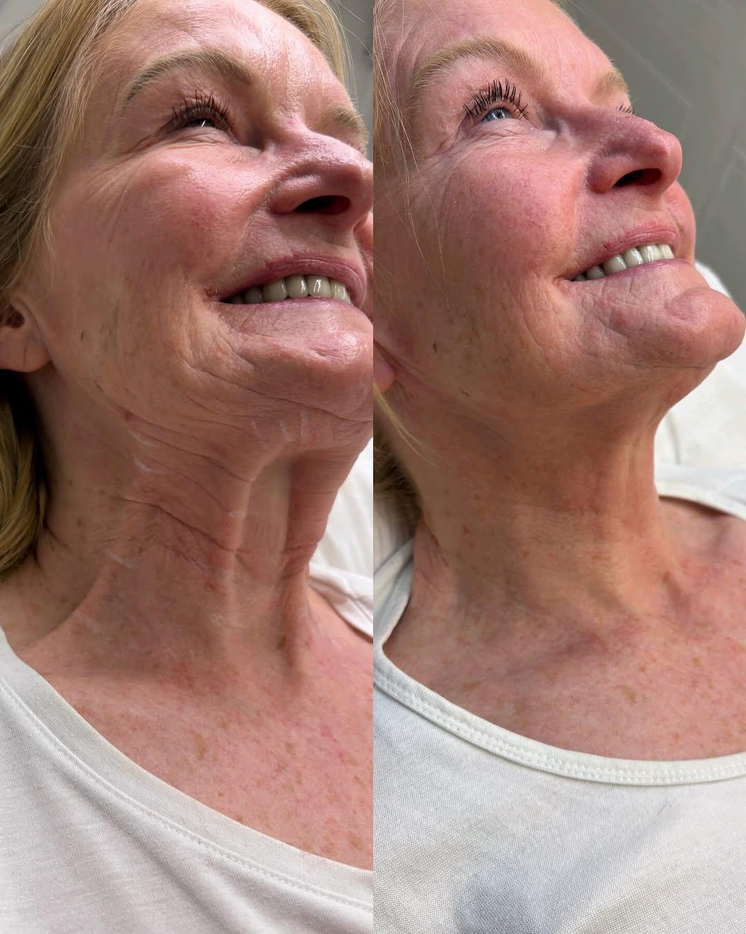 Neck Rejuvenation