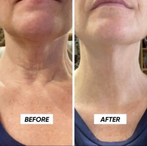Neck Rejuvenation
