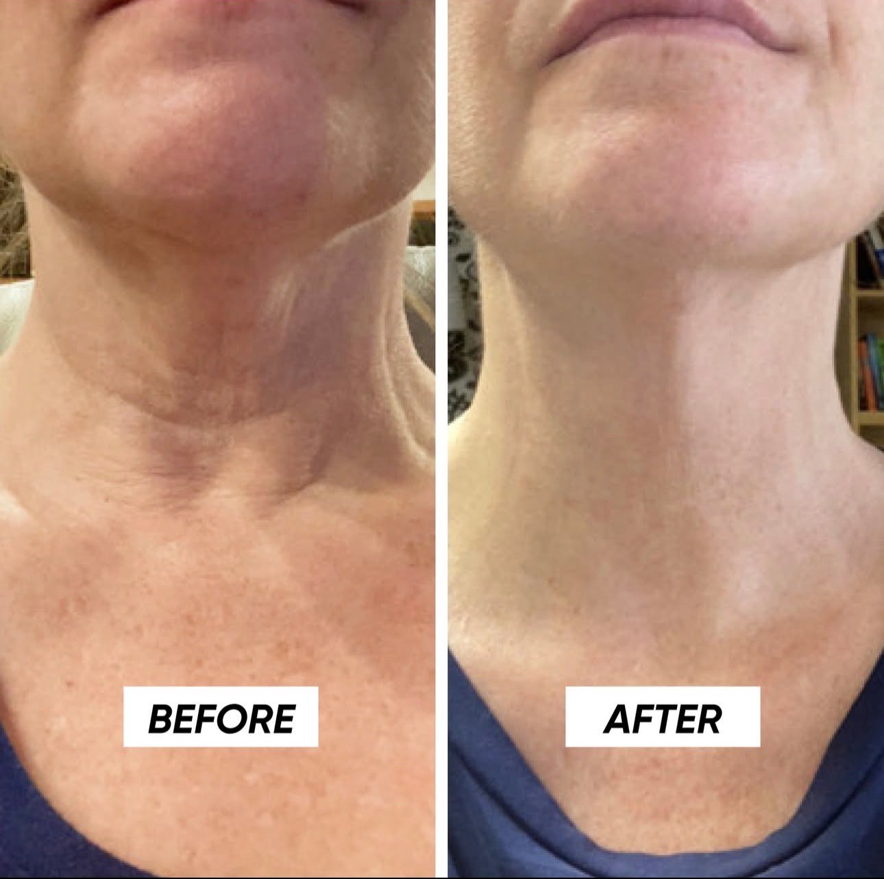 Neck Rejuvenation