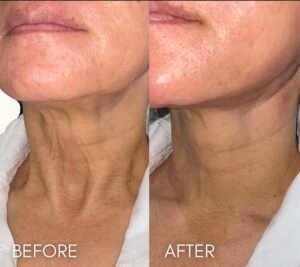 Neck Rejuvenation