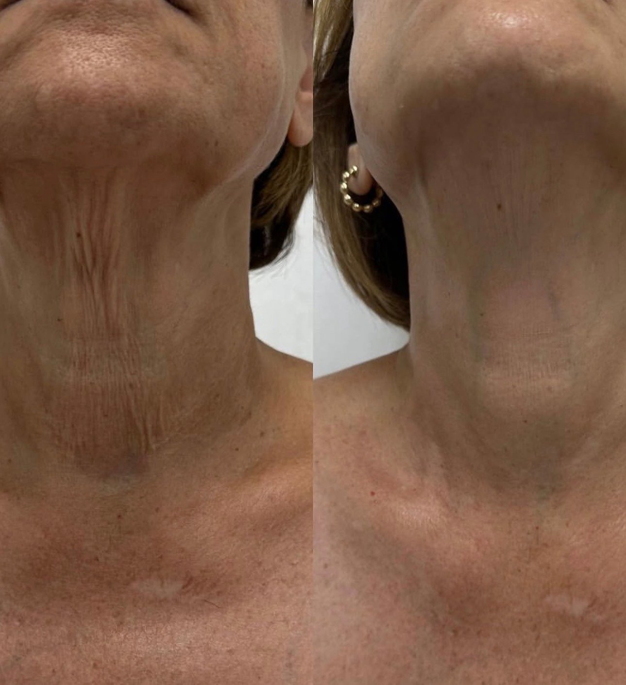 Neck Rejuvenation