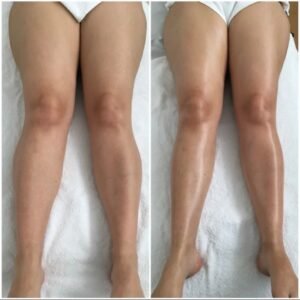 Manual Lymphatic Drainage