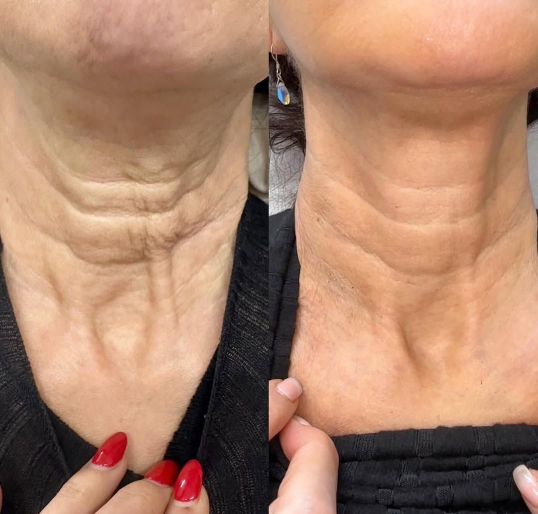 Neck Rejuvenation