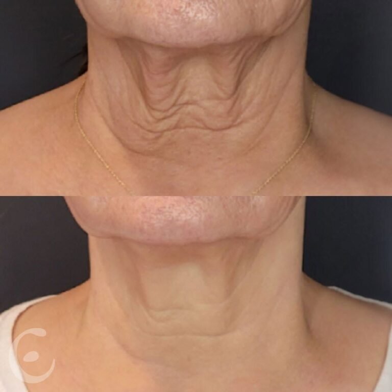 Neck Rejuvenation