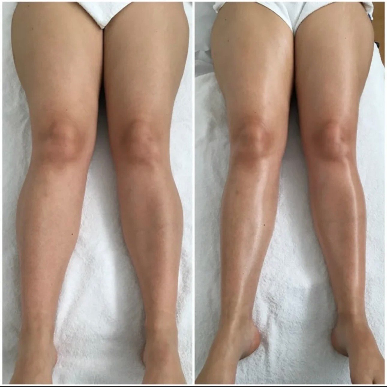 Body sculpting result
