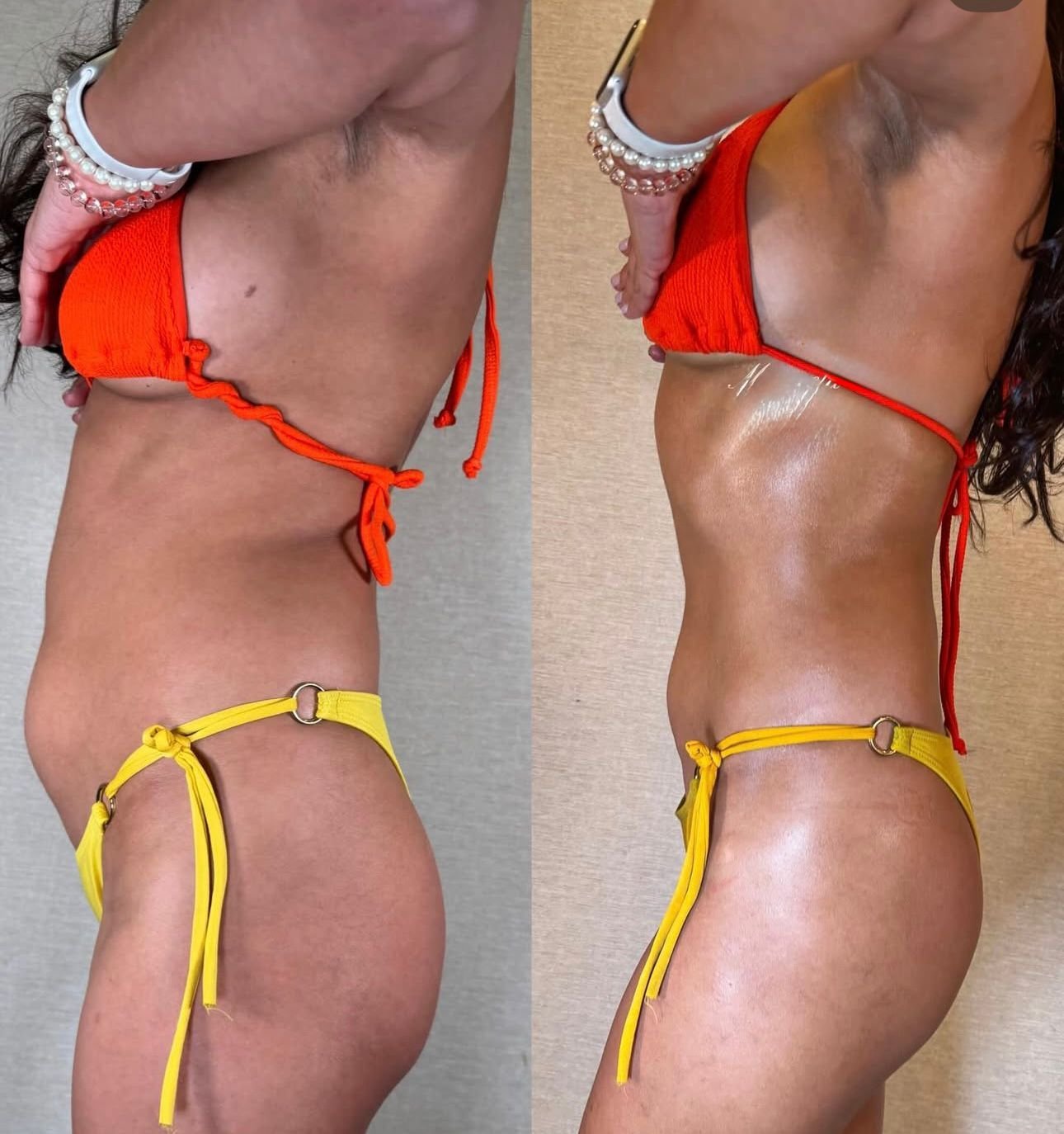 Body sculpting result