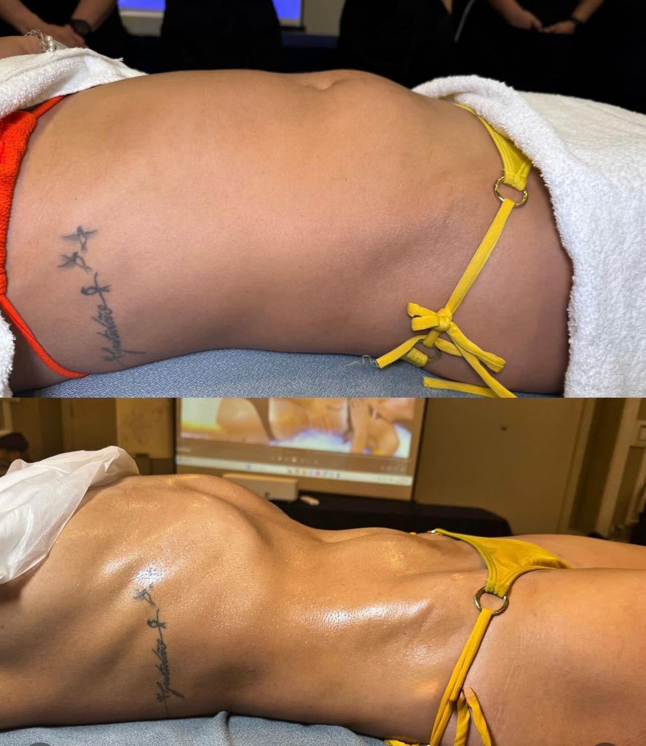 Body sculpting result