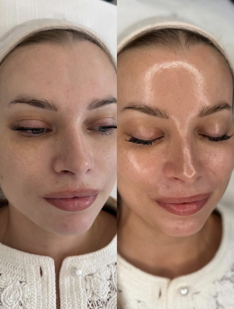 Glass skin result